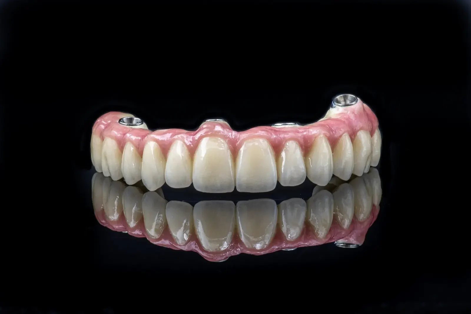 YDL metal-ceramic full-arch restoration