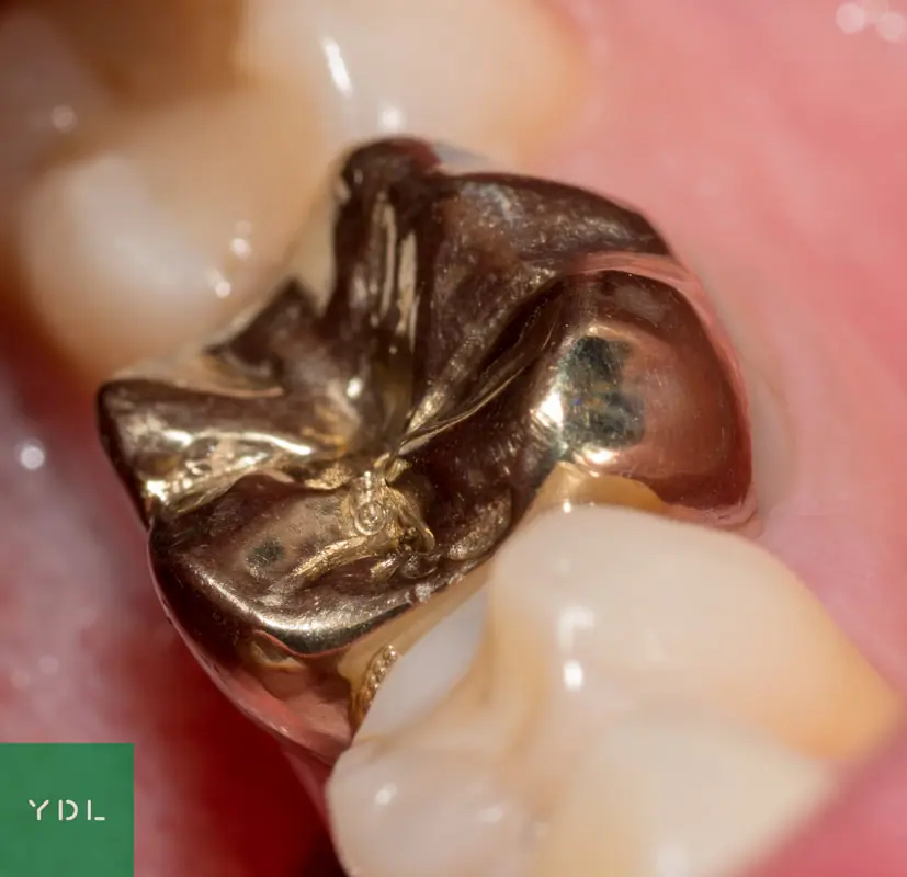 Au onlay