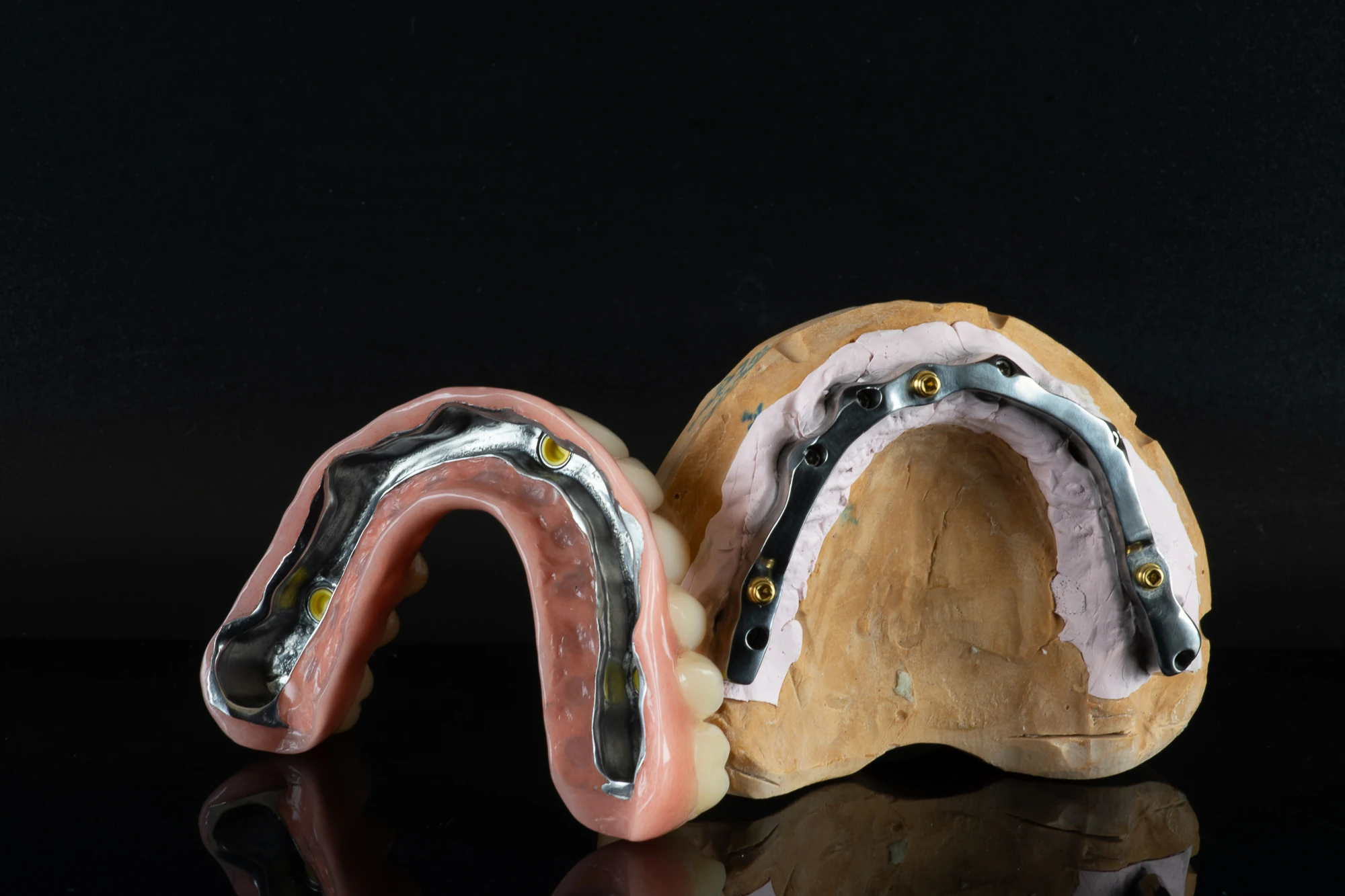 YDL implantátumos overdenture restauráció