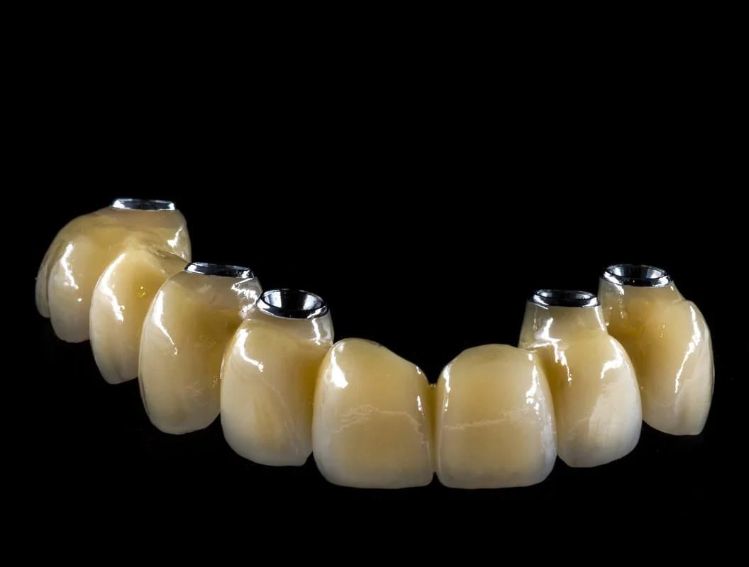 Screw-retained crowns and bridges, image 3