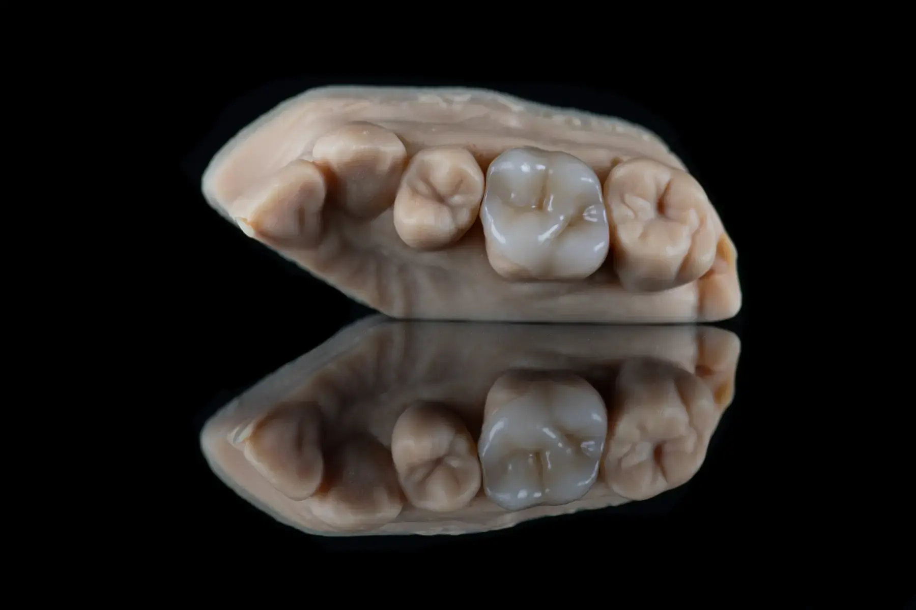 CAD/CAM kompozit, 1. kép