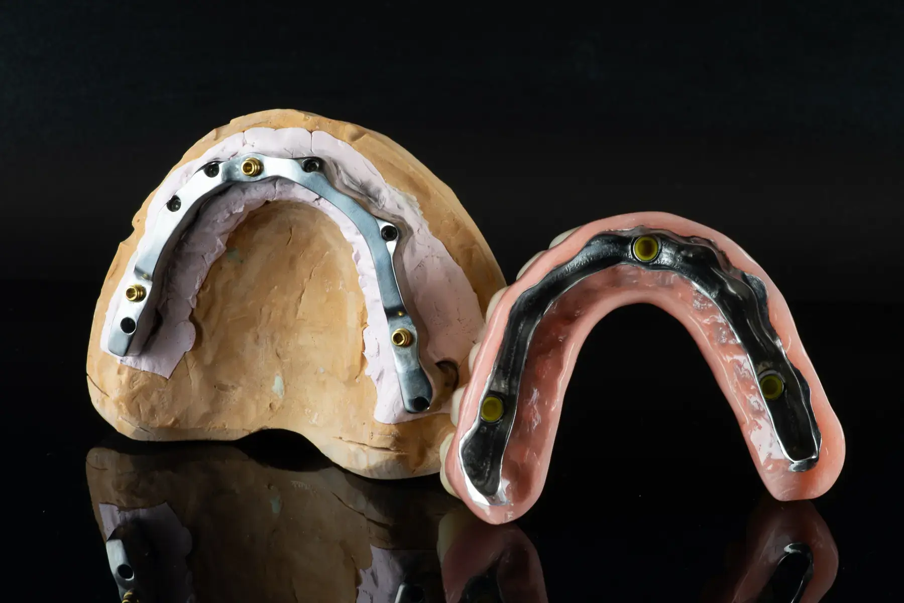 Overdenture, 1. kép