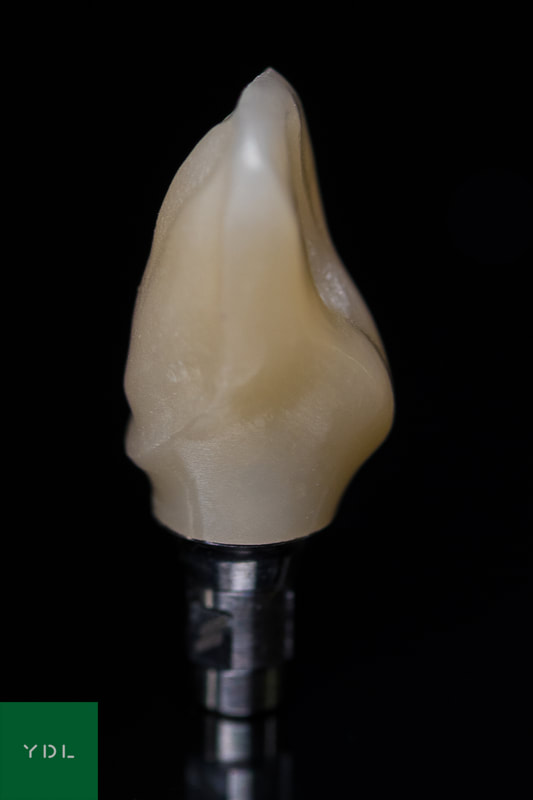Zr crown on Variobase AS abutment
